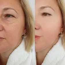 Ellansé y diversidad cutánea: una mirada intercultural sobre la armonía facial